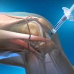 knee injections arthritis Core Medical Group Brooklyn Ohio