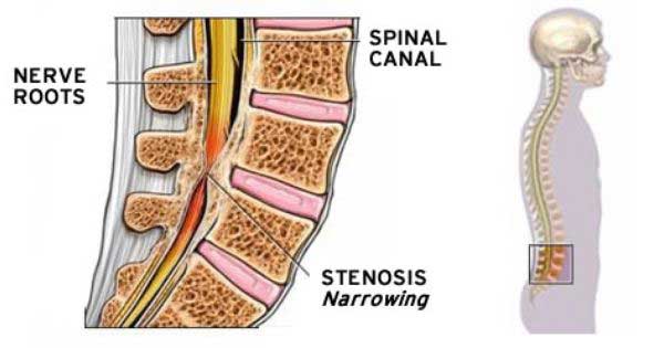 spinal stenosis Core Medical Group Brooklyn Ohio